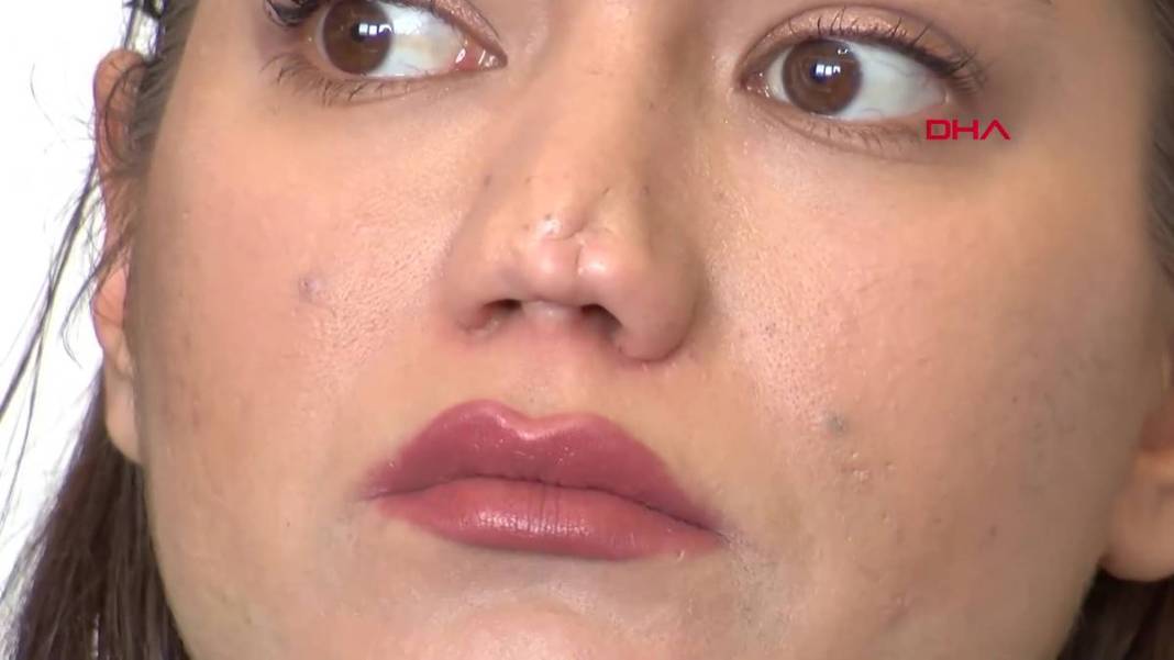 Estetik operasyon sonrası burnu düştü! Aynı doktora iki ameliyat oldu, sonuç değişmedi, mahkemeye verdi 18